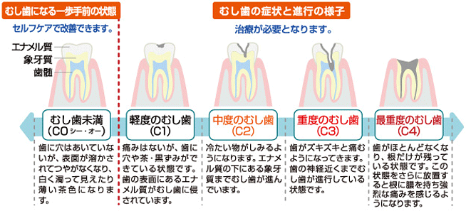 虫歯の進行の様子